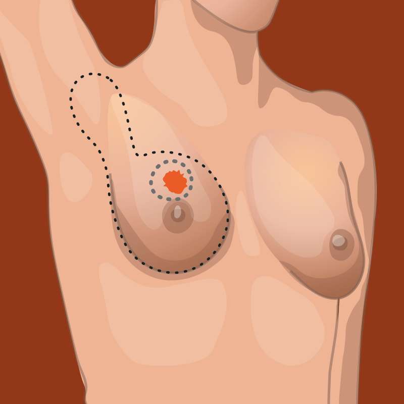 breast tumor